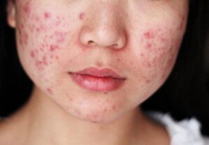 Top 7+ Cách ngăn ngừa mụn trứng cá hiệu quả